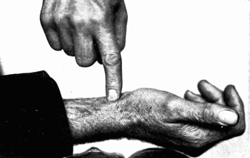 Fig. 58.—Another method of finger-tip palpation of the radial artery. (Graves.)