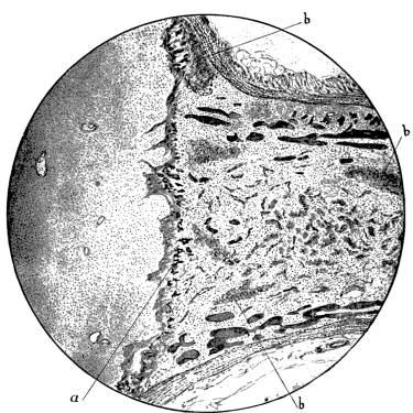 Bone in scurvy. Microscopic pathology 