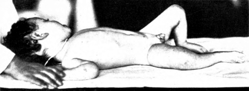 Infant with marked scurvy. Characteristic position