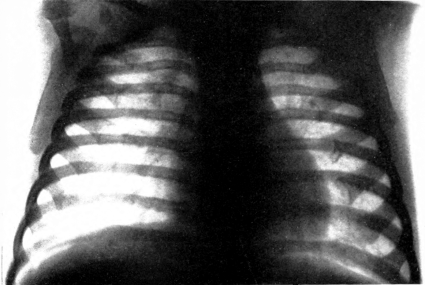 Scorbutic beading of ribs. Roentgenogram
