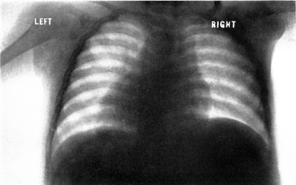 Cardiac enlargement. Roentgenogram