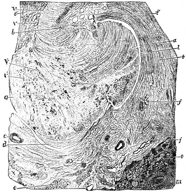 Section of an old gumma of the liver