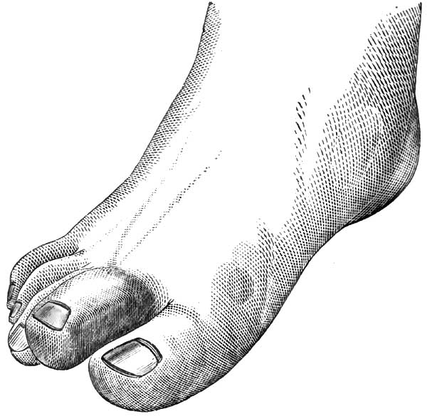 Spongio arthrite definition