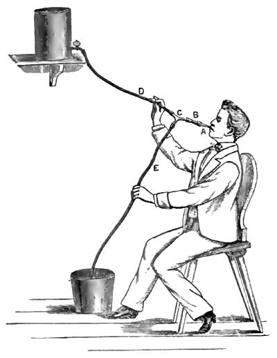 Use of Rosenthal siphon