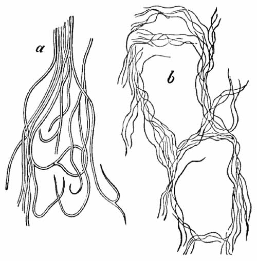 Elastic fibers from the sputum