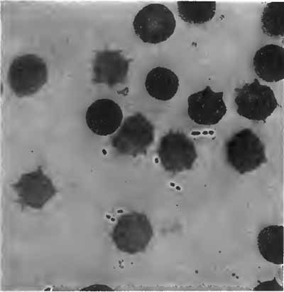 Diplococcus pneumoni in the blood