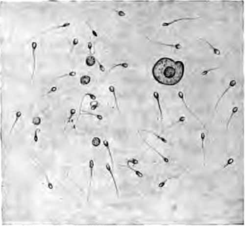 Spermatozoa in urine