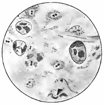 Diplococcus pneumoni