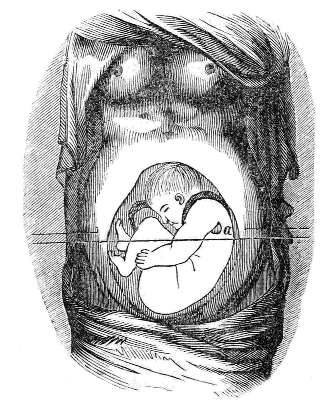 Fœtus
in a presentation of the Pelvis