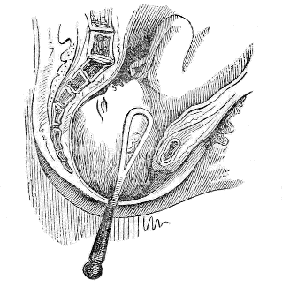 use of forceps