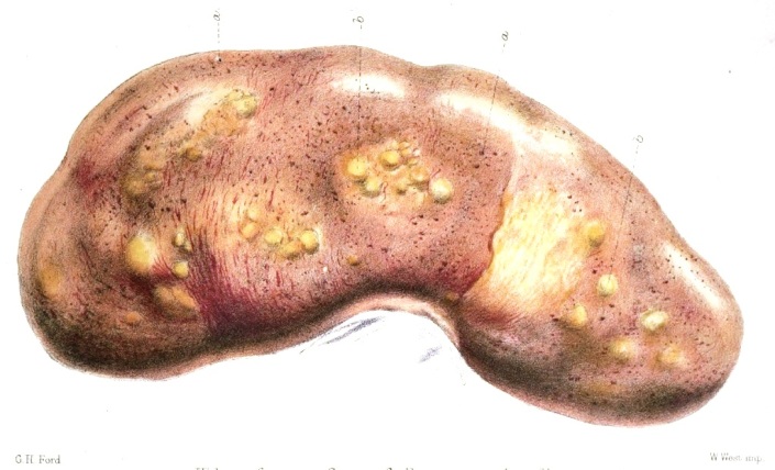 Kidney from a Case of Permanent Jaundice
