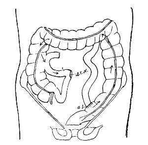 Diagram of the lower bowel in a female patient.