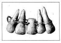 Examples of dental prosthesis