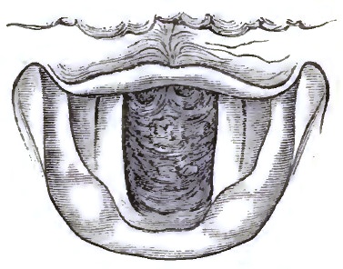 Same case as Fig. 25: posterior wall