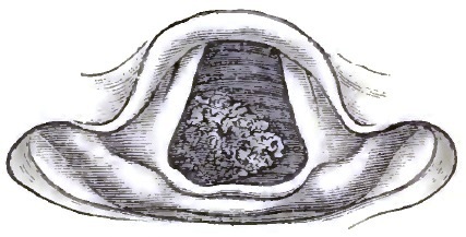 Papilloma of Trachea