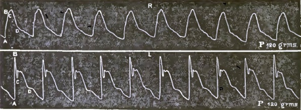 Right and Left Radial Pulse in Aneurism of Aorta
