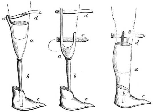 Shows amputation above knee with prosthetic and
  two styles of amputation below the knee with prosthetic.