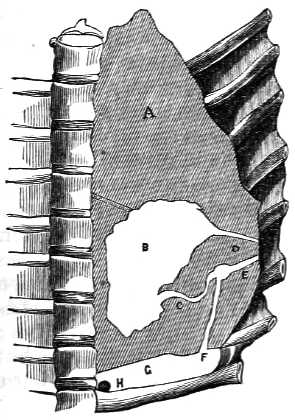 Section of lung with spine and ribs shown.