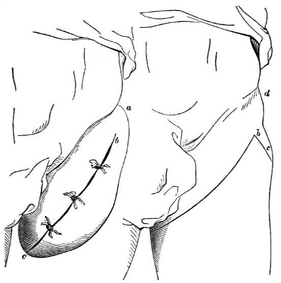 Illustration of where to cut and how to sew together for amputation of hip-joint.