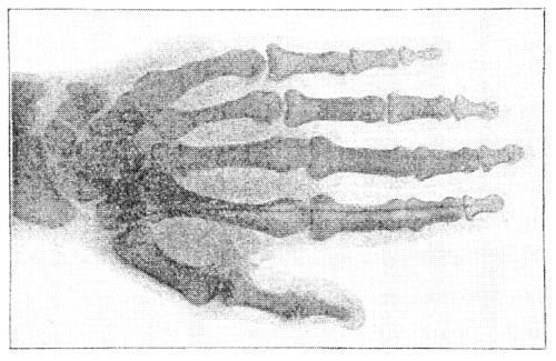Hand of Eugene d’Albert