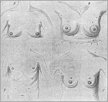 Instances of redundant mammary glands and nipples (hypermastism).